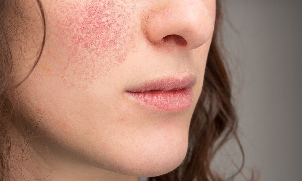 What is Eczema?