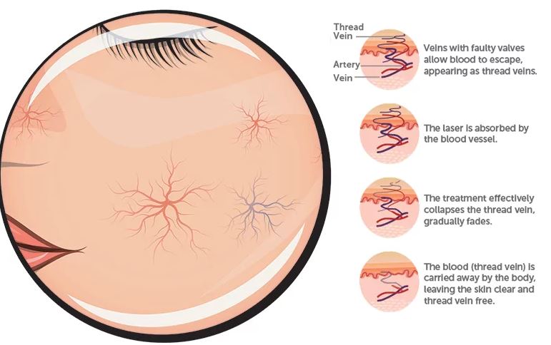 Facial Veins - Exquisite Laser Clinic