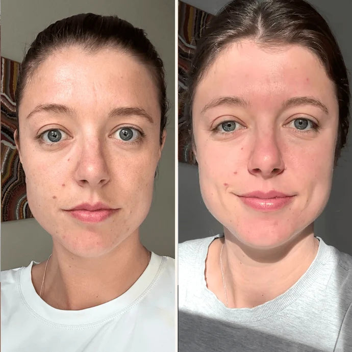 Trudermal Microneedling Infusion Kit - Exquisite Laser Clinic 