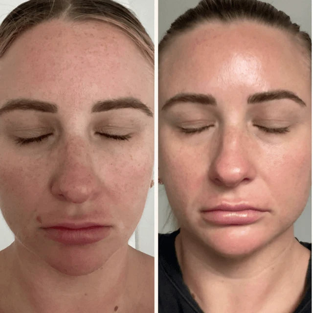 Trudermal Microneedling Infusion Kit - Exquisite Laser Clinic 