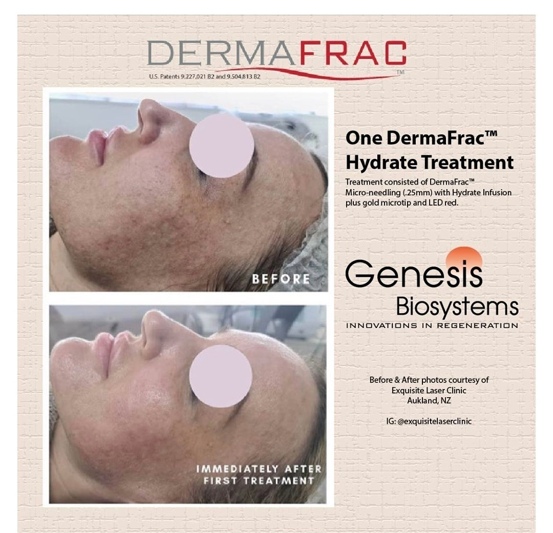 Exquisite Laser Clinic  skin treatment Dermafrac 4 in 1 Skin Rejuvenation