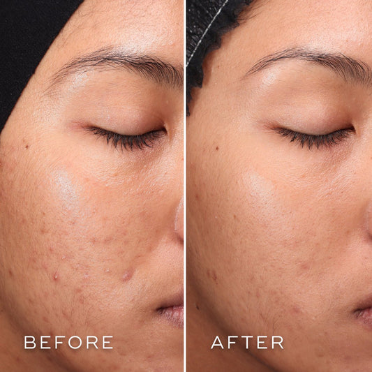 Medik8 Press & Clear - Exquisite Laser Clinic