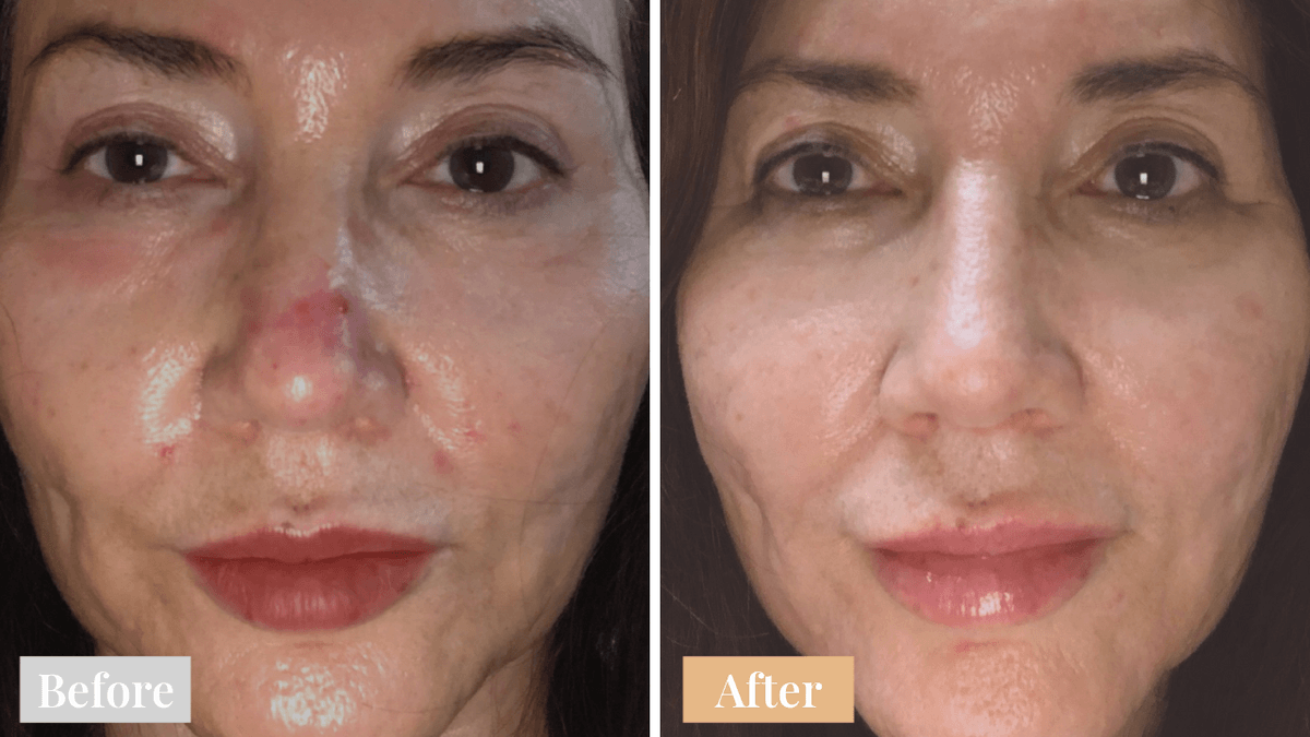 Omnilux Contour FACE LED Home Treatment Mask **Top Seller** - Exquisite Laser Clinic