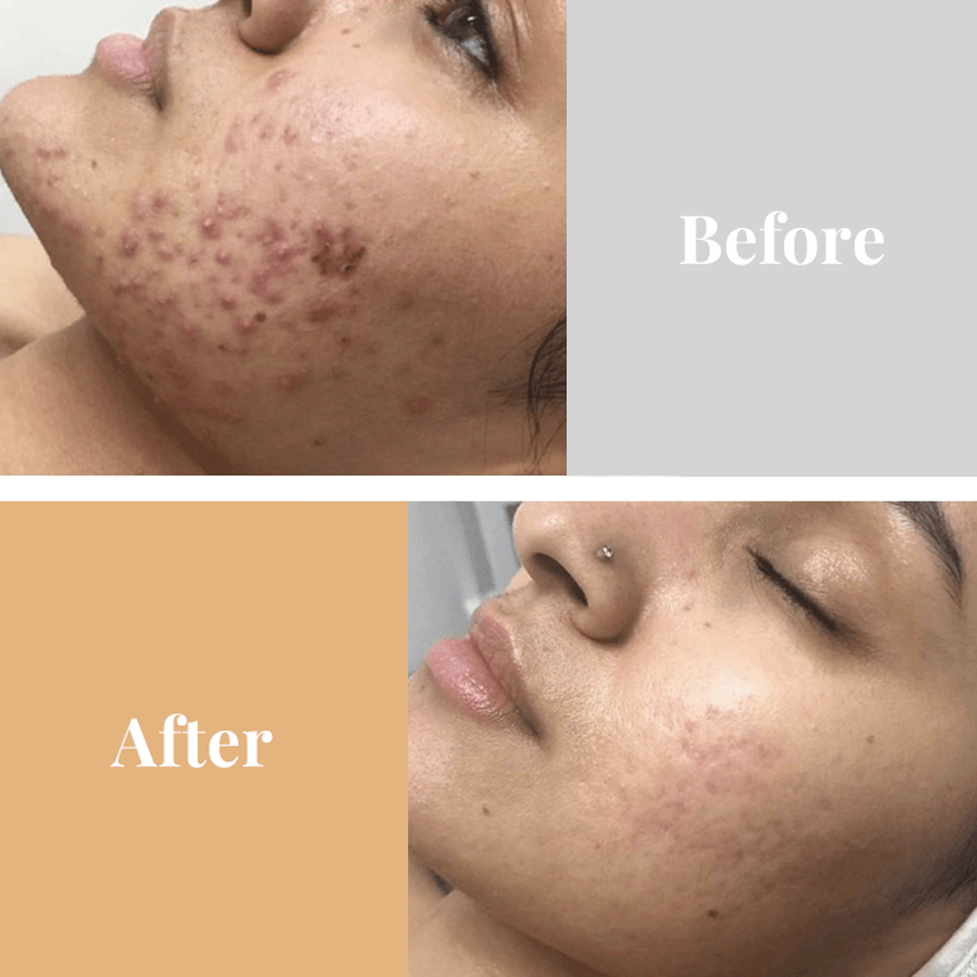 omnilux skincare Omnilux Acne CLEAR At home LED Light Treatment **Pre Order**