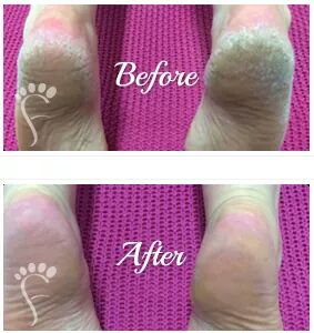 Probeauty skincare Foot Peel